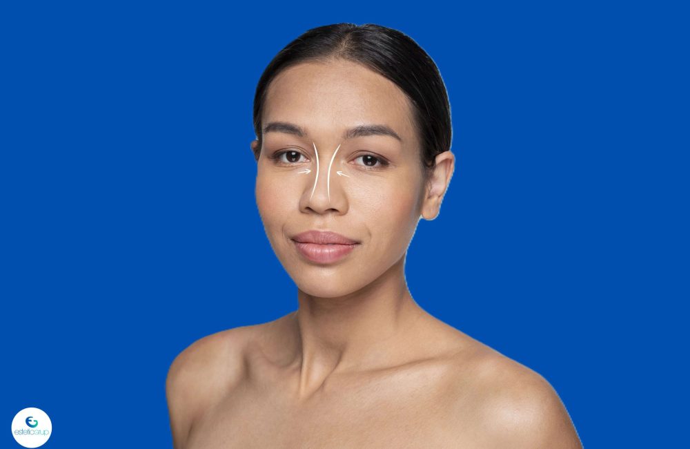 Tipos de rinoplastia ¿Cuál es mejor Diferencias y resultados